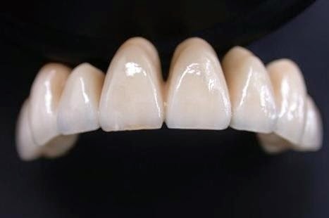 Răng sứ Venus Răng sứ Venus